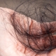 The most common root causes of hair loss — trichology guide