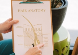 Alopecia universalis — complete hair loss on scalp and body
