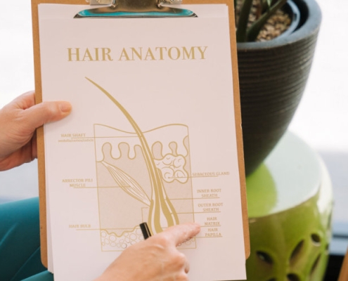 Alopecia universalis — complete hair loss on scalp and body